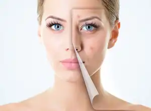 وازلین برای رفع آکنه